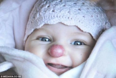 fetita-care-sa-nascut-cu-nasul-rosu-ca-de-clovn-a-fost-operata