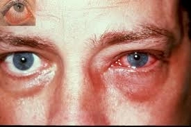 glaucomulboala-orbirii-in-tacere