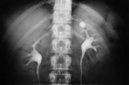 -atentie-la-lichidele-care-favorizeaza-aparitia-pietrelor-la-rinichi