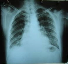 200-de-elevi-gorjeni-suspecti-de-tbc-din-cauza-profesorului