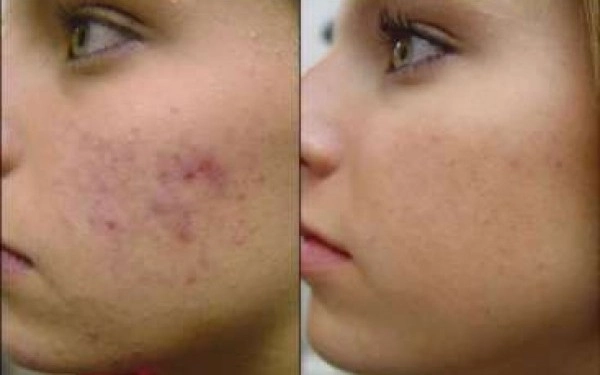 a-scapat-de-acnee-intro-singura-zi-video