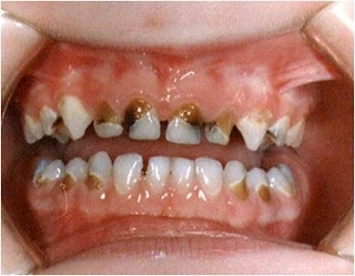 dintii-tai-sunt-plini-de-carii-afla-ce-boli-poti-avea