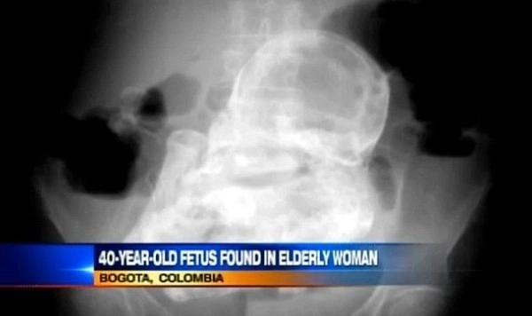 incredibil-a-trait-40-de-ani-cu-un-copil-mort-in-burta-