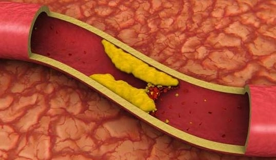 medicamentele-anticolesterol-efecte-adverse-serioase