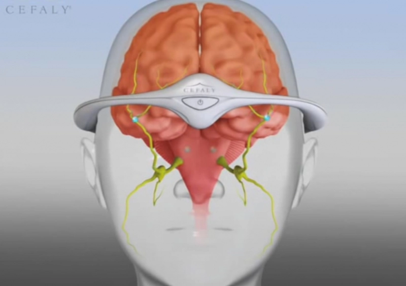 metoda-inedita-de-a-scapa-de-migrena-solutie-belgiana-video