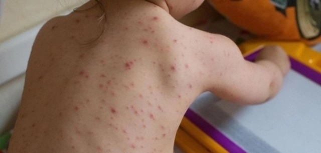 400-de-cazuri-noi-de-rujeola
