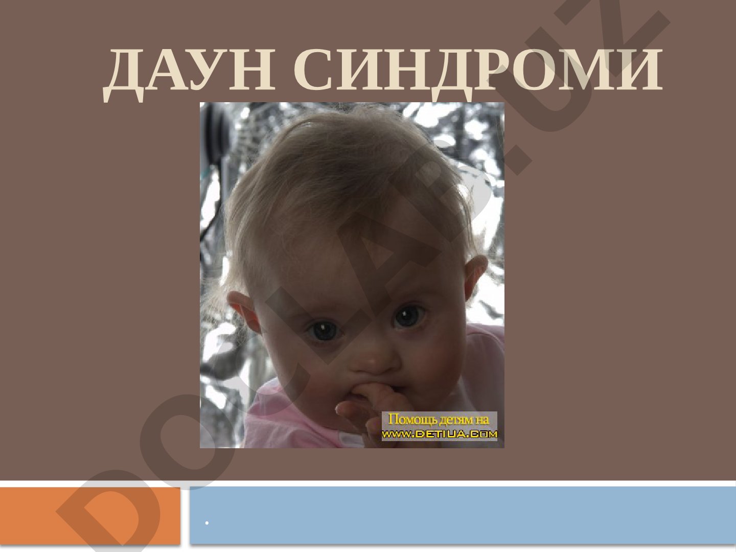 Daun sindromi (21 xromosomaning trisomiyasi)