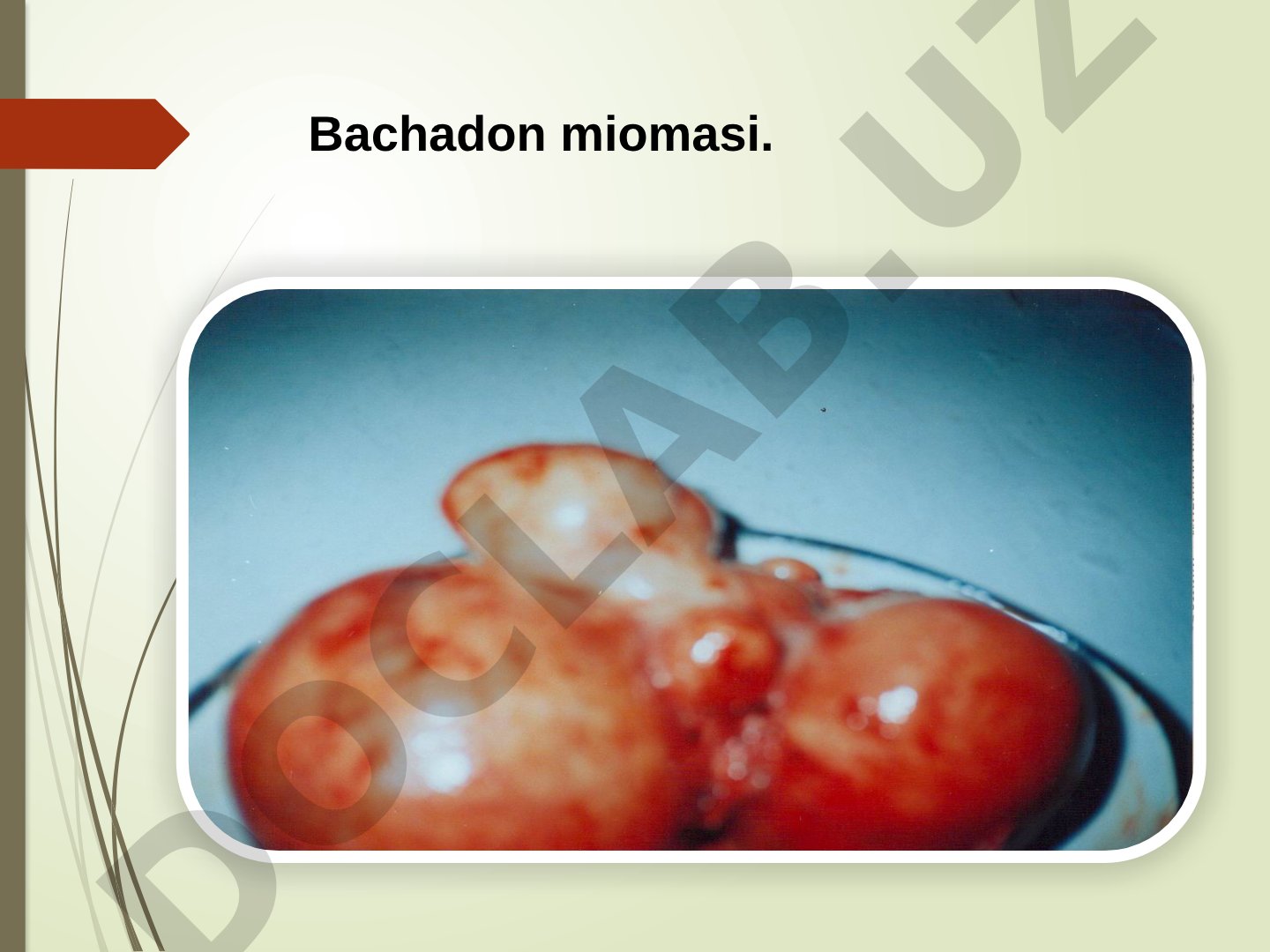 Bachadon miomasi etiologiyasi va uchrash statistikasi