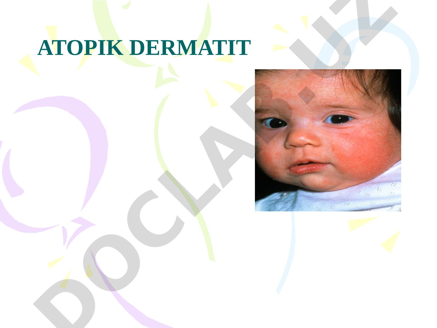 Atopik Dermatit