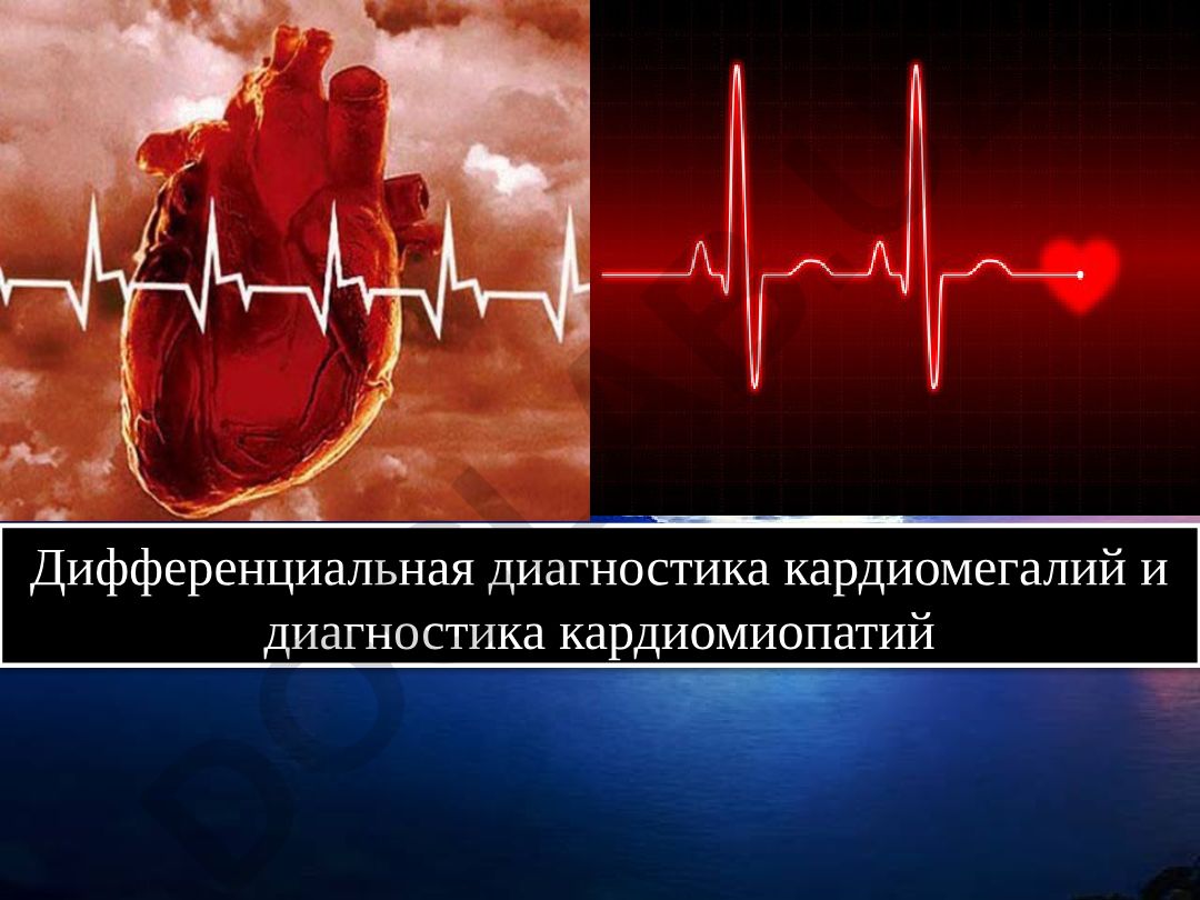 Дифференциальная диагностика кардиомегалий и кардиомиопатий