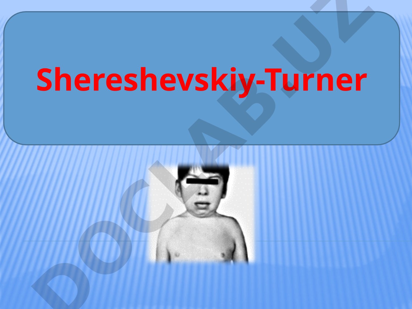 Shereshevskiy-Turner sindromi