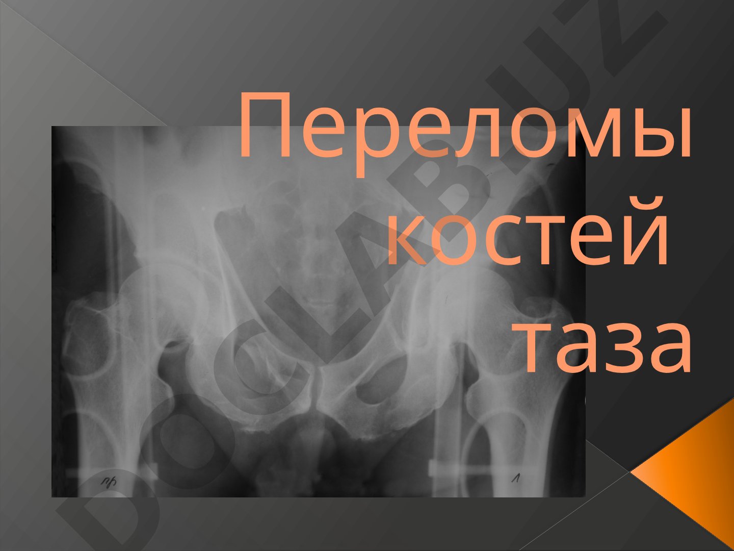 Переломы костей таза