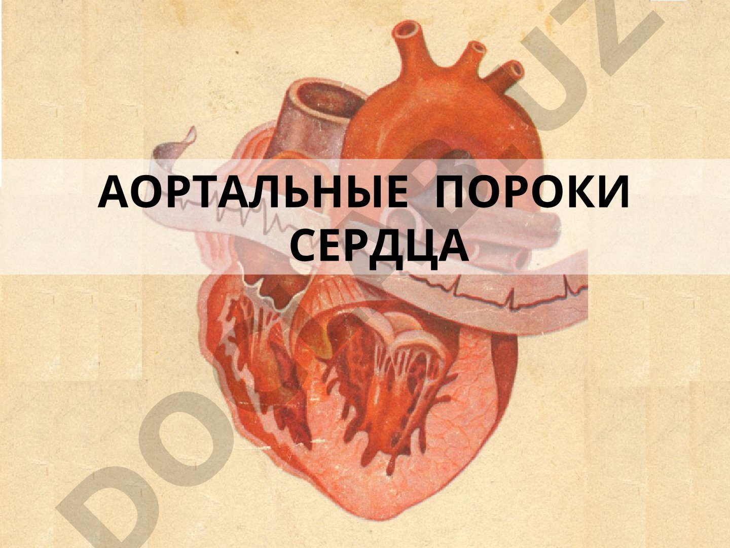 Аортальные пороки сердца: виды клапанных пороков