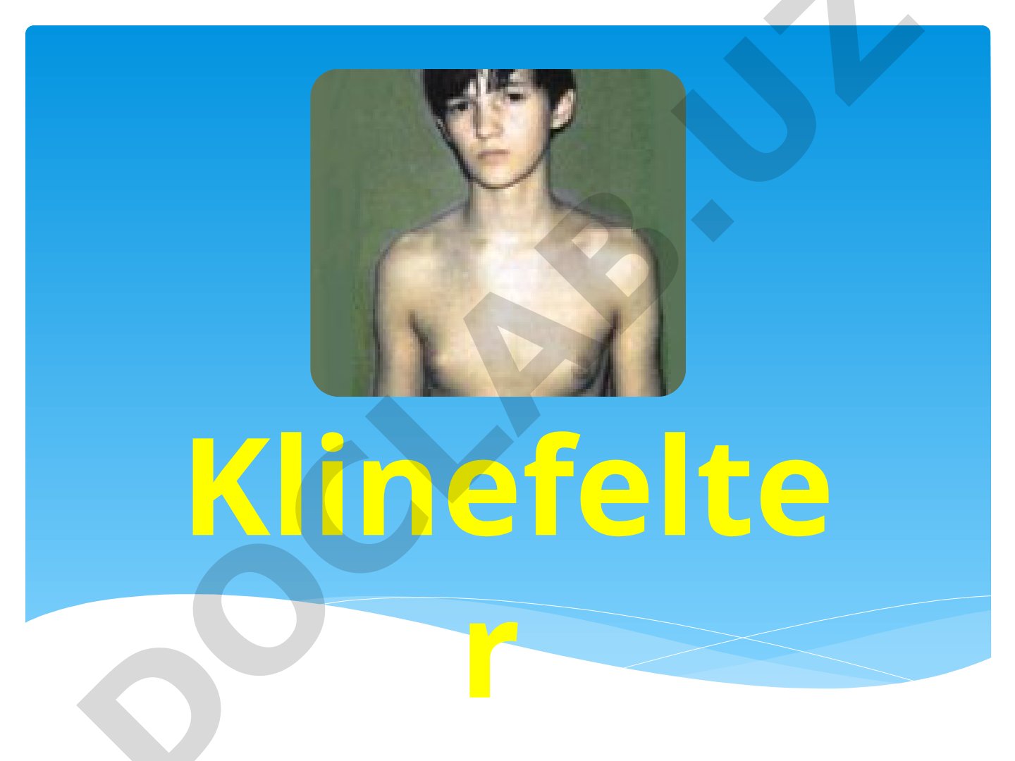 Klinefelter sindromi