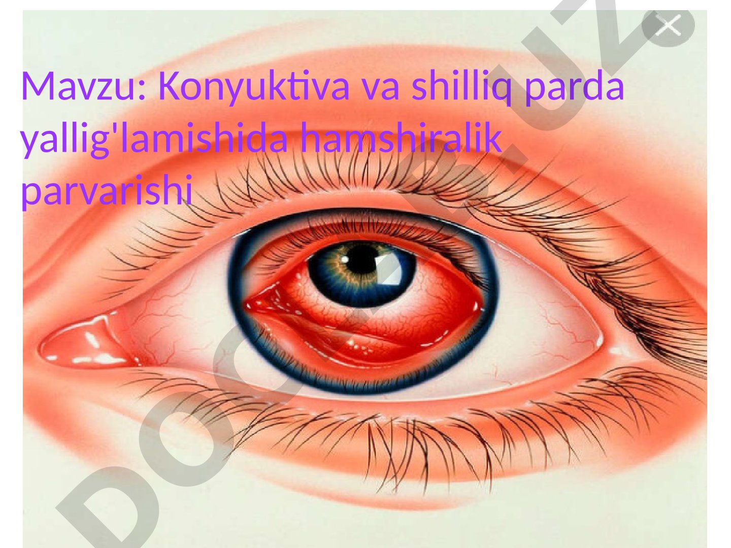 Konyuktiva va shilliq parda yallig'lamishida hamshiralik parvarishi