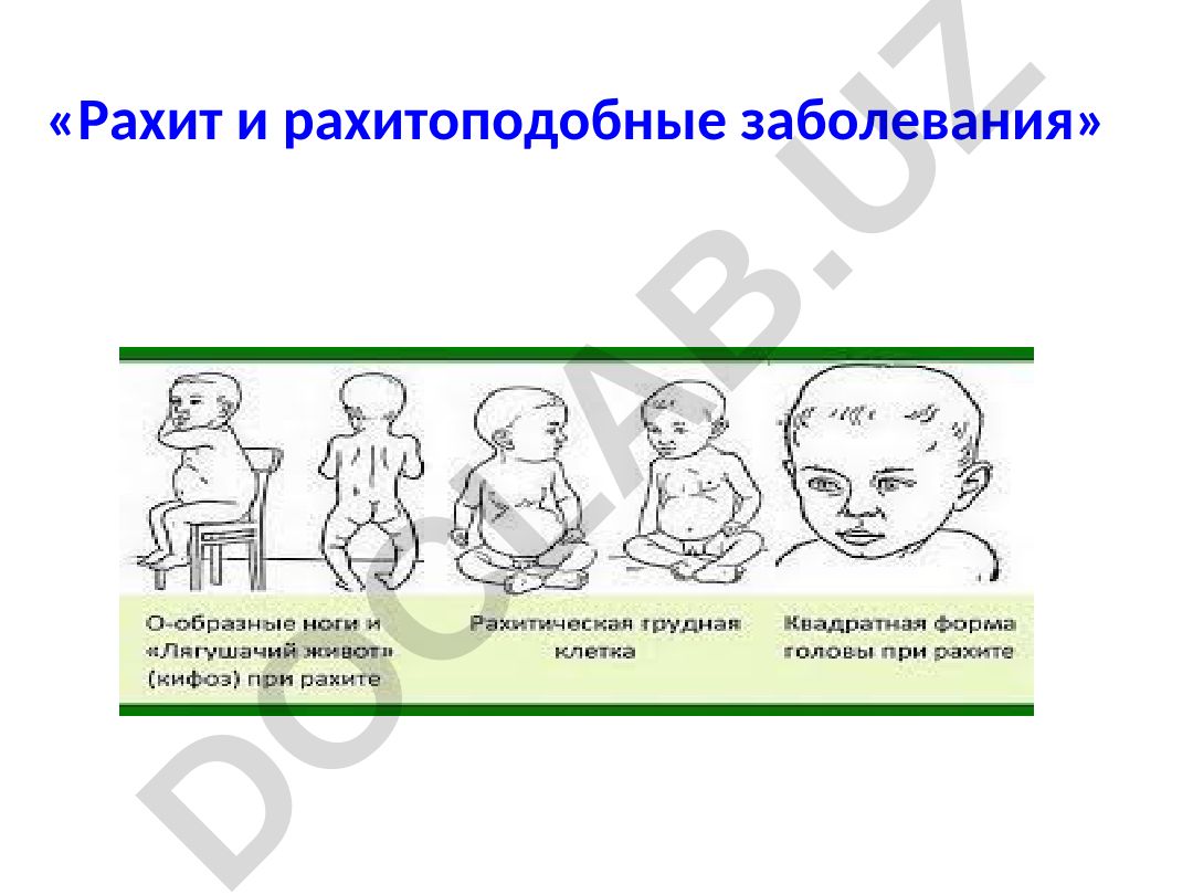 Рахит и рахитоподобные заболевания у детей