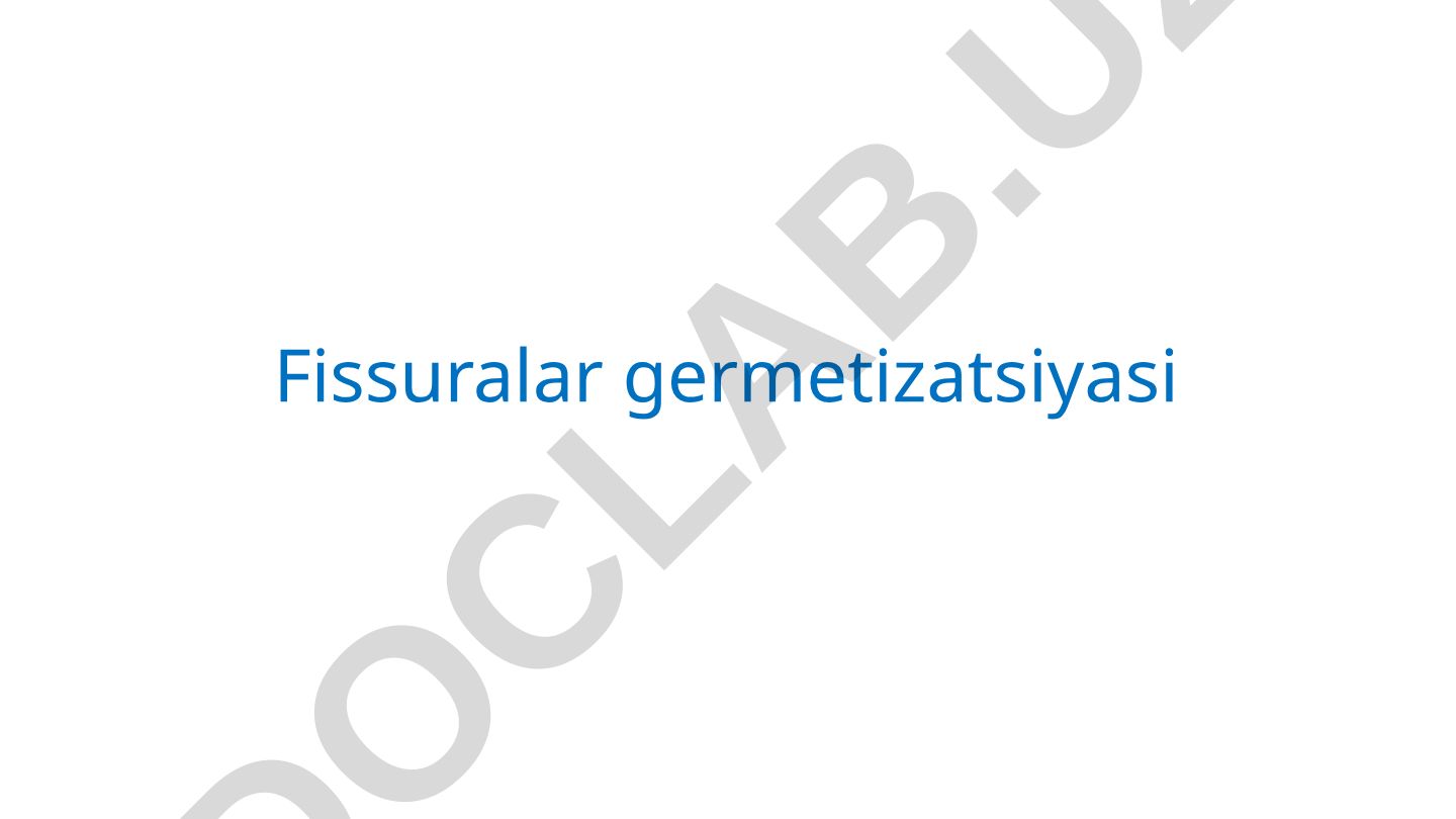 Fissuralar germetizatsiyasi - tish kariesini profilaktika usuli