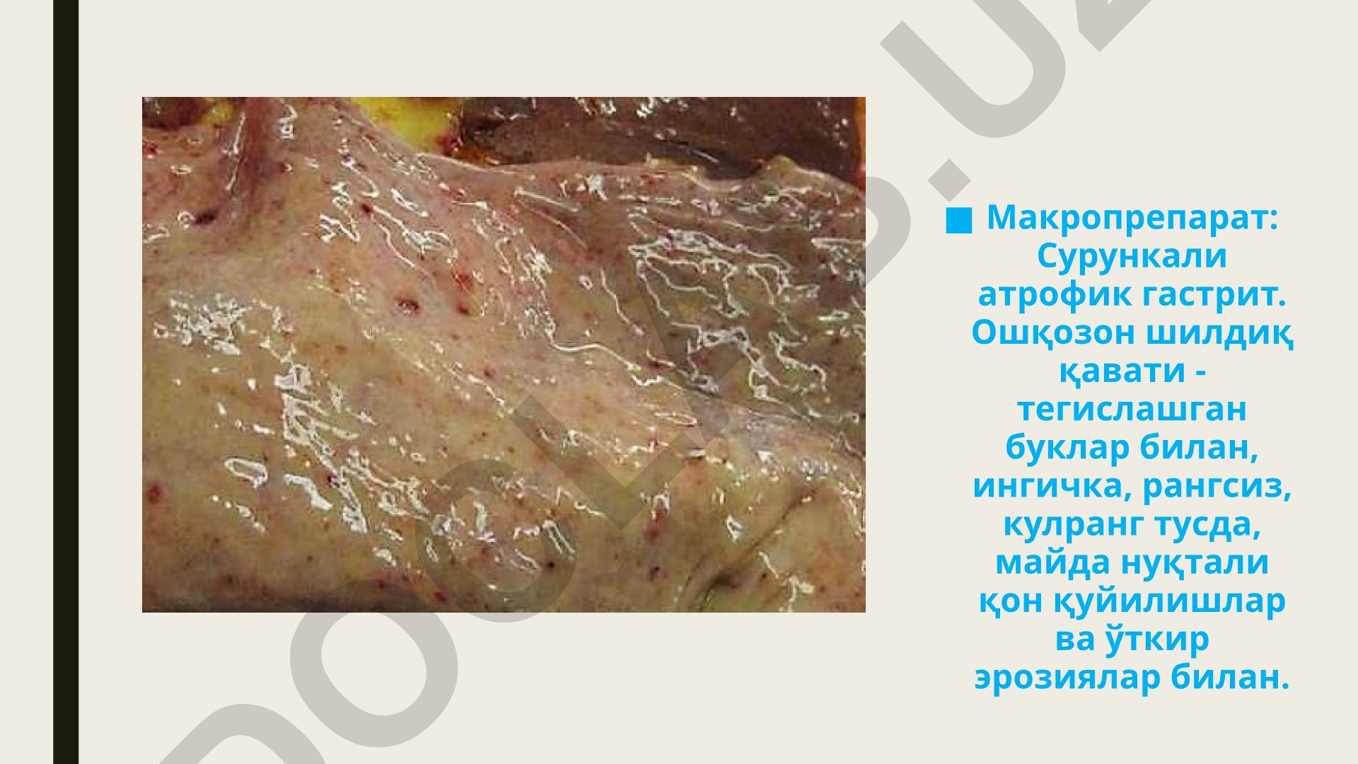 Сурункали атрофик гастрит, буйрак амилоидози, юрак миокардининг жигарранг атрофияси, ўрта пневмония