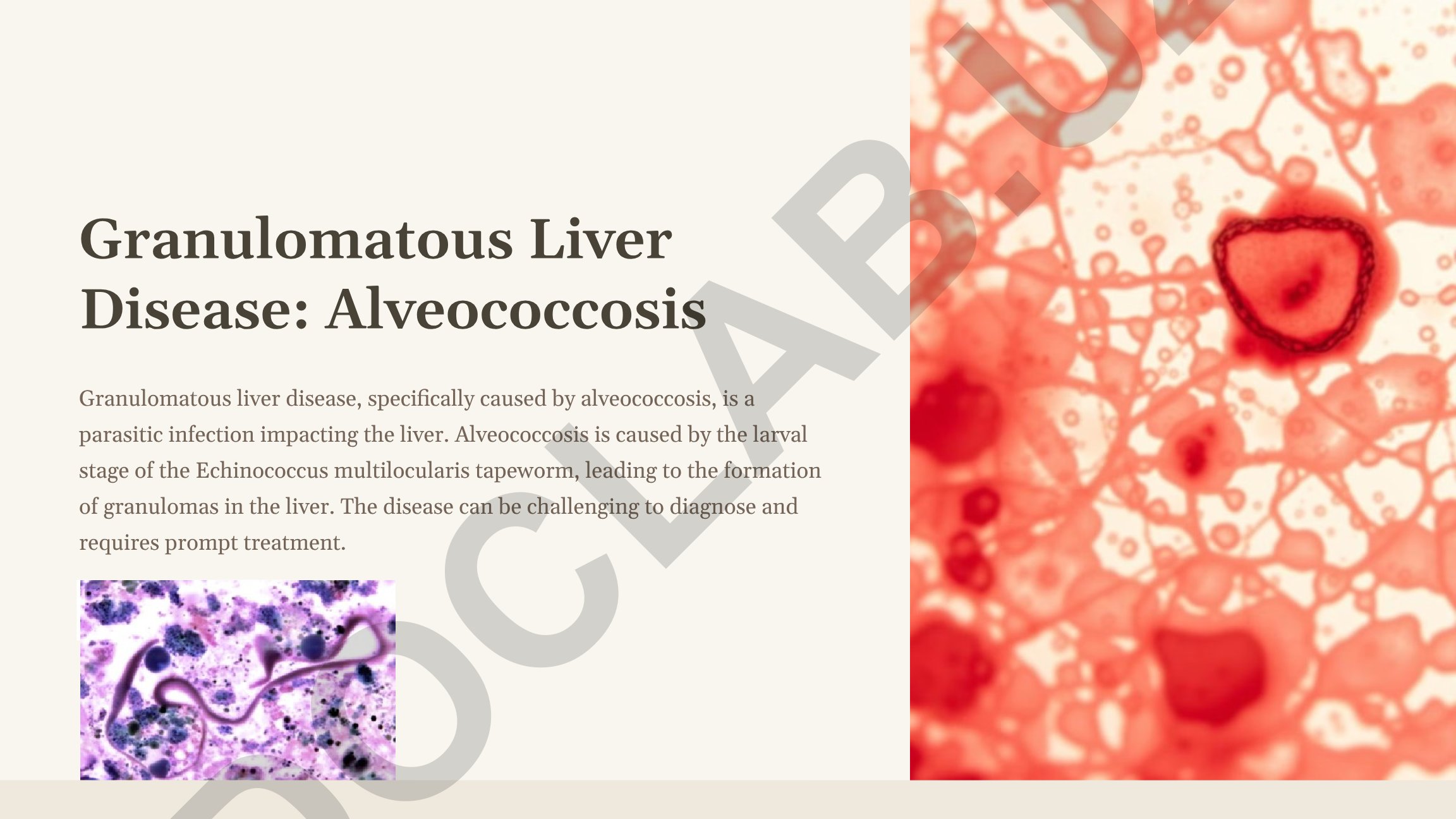 Granulomatous Liver Disease: Alveococcosis