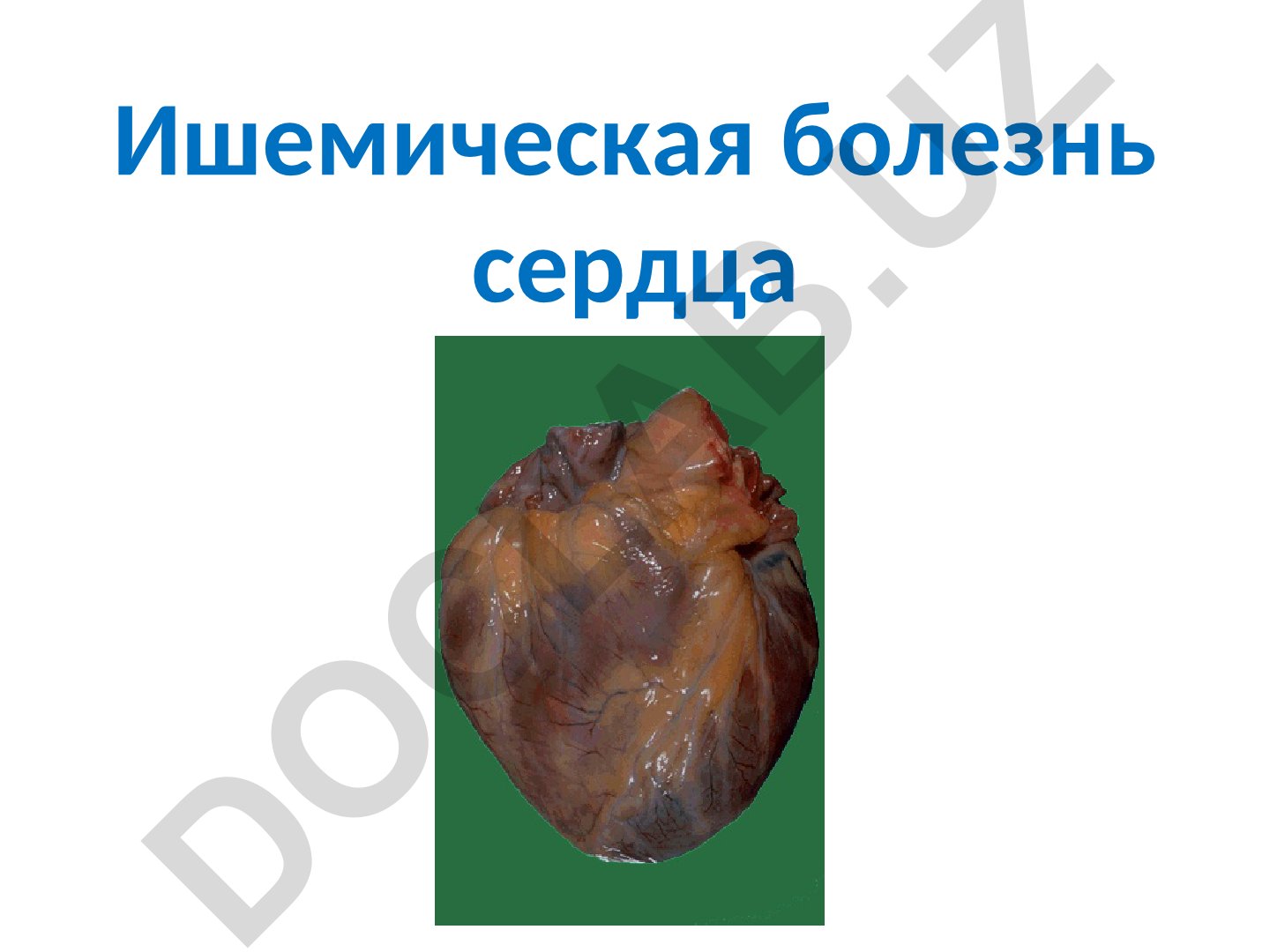 Ишемическая болезнь сердца: причины, механизмы развития и патологические изменения