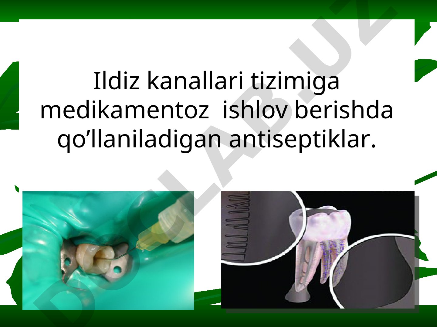 Ildiz kanallari tizimiga medikamentoz ishlov berishda qo’llaniladigan antiseptiklar