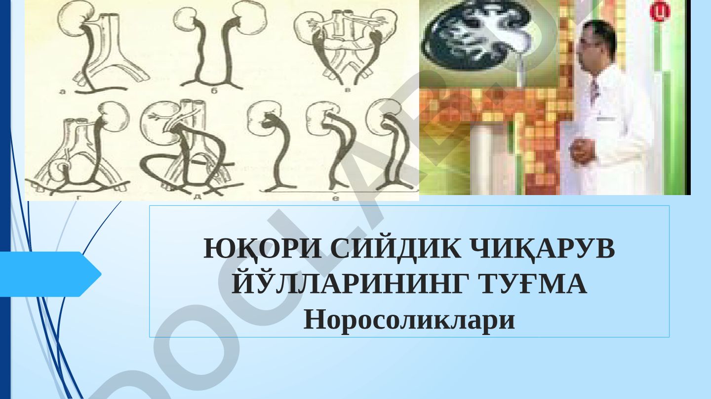 Юқори сийдик чиқариш йўлларининг туғма норасоликлари