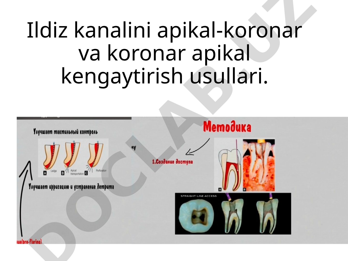 Ildiz kanalini apikal-koronar va koronar apikal kengaytirish usullari