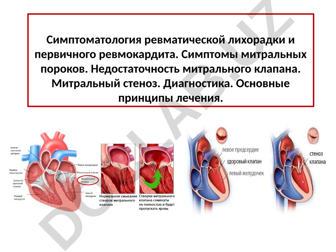 Симптоматология ревматической лихорадки и первичного ревмокардита
