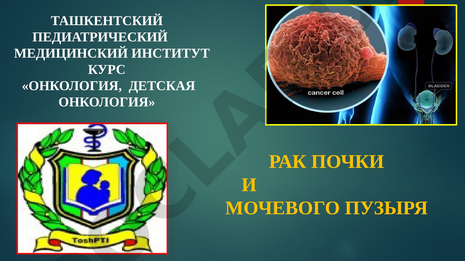 Рак почки и мочевого пузыря