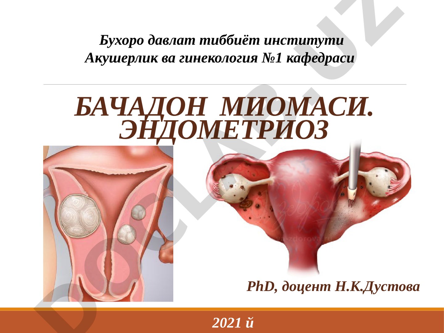 Бачадон миомаси. эндометриоз
