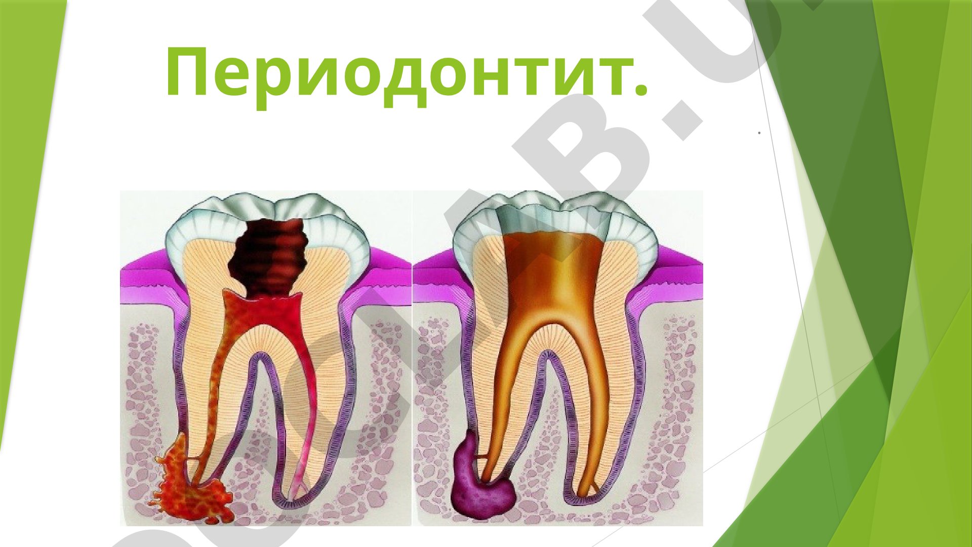 Периодонтит
