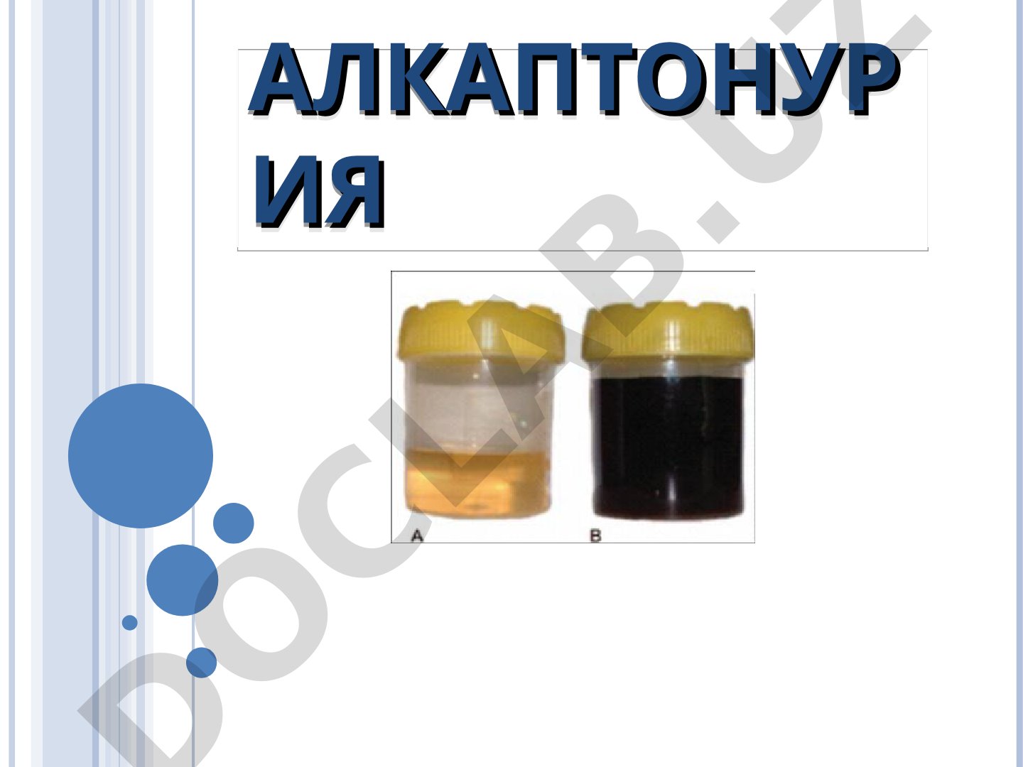 Наследственное заболевание обмена тирозина, вызванное мутацией гена HGD