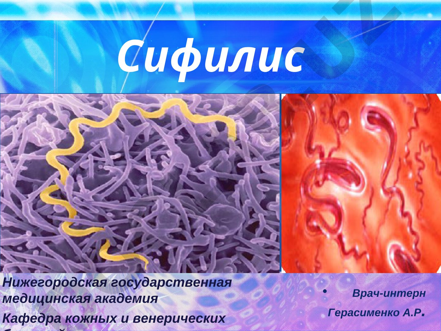 Сифилис