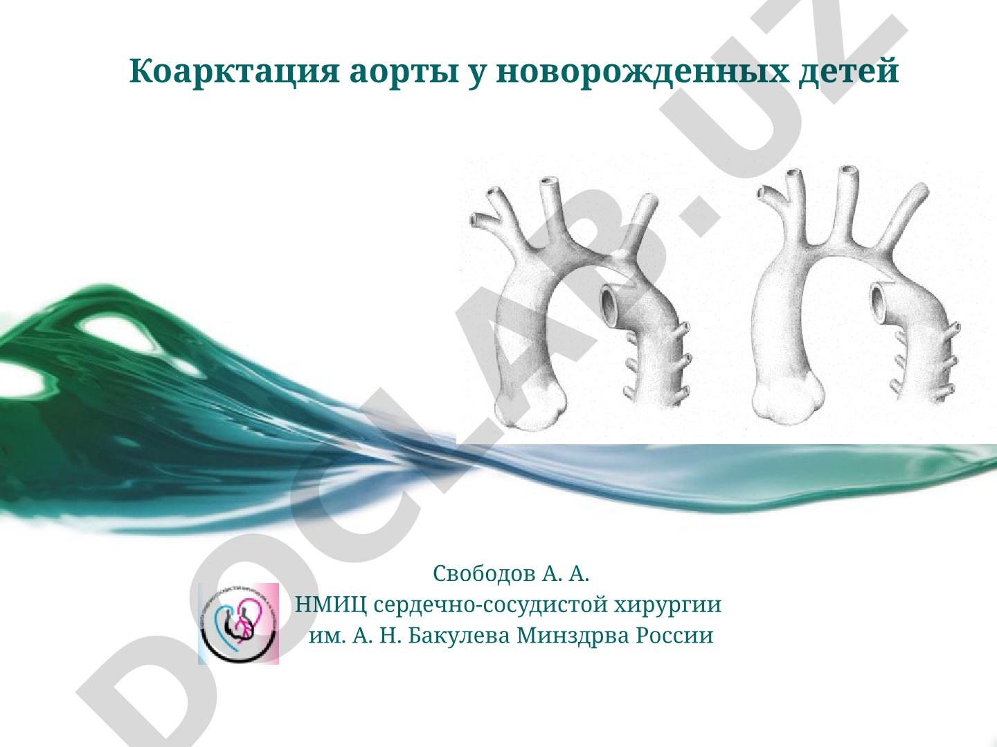 Коарктация аорты у новорожденных детей