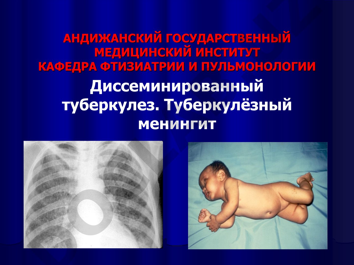 Диссеминированный туберкулез и туберкулезный менингит