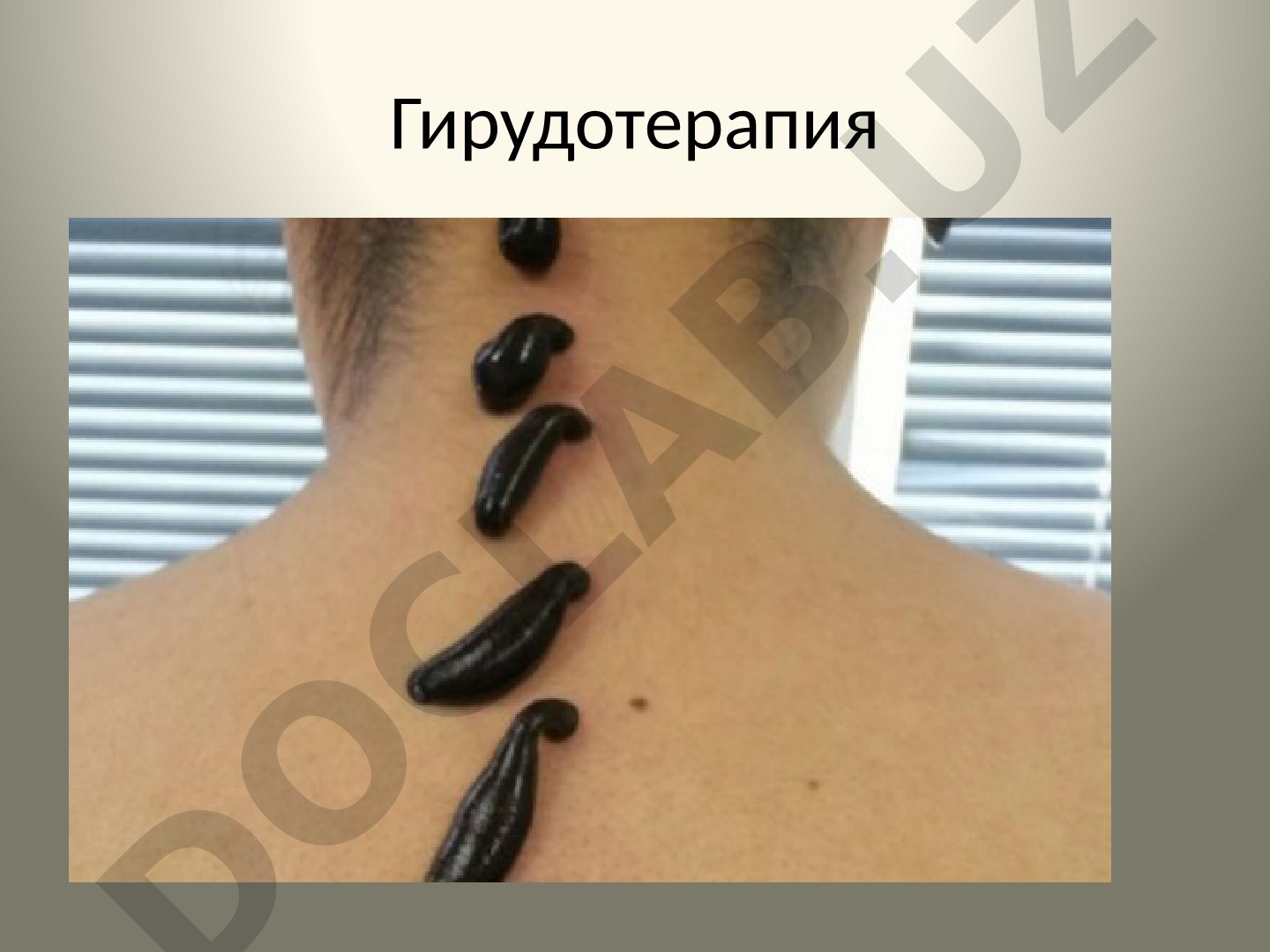 Гирудотерапия: точки постановки и методики