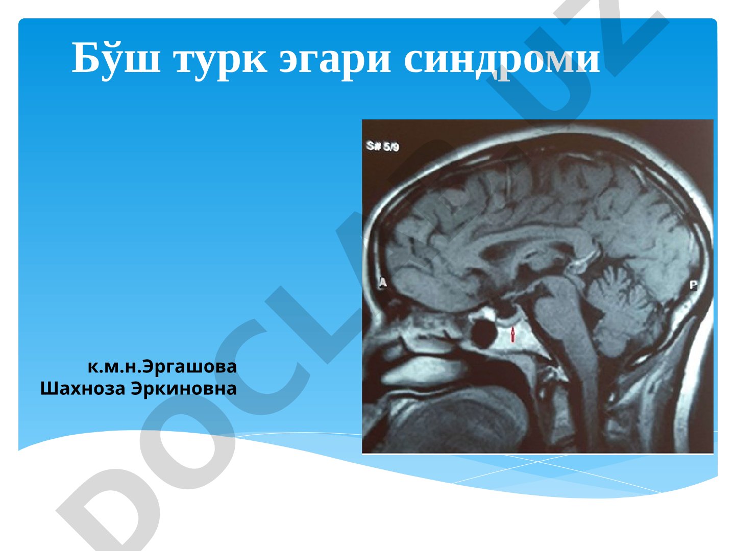 Bo'sh turk egari sindromi