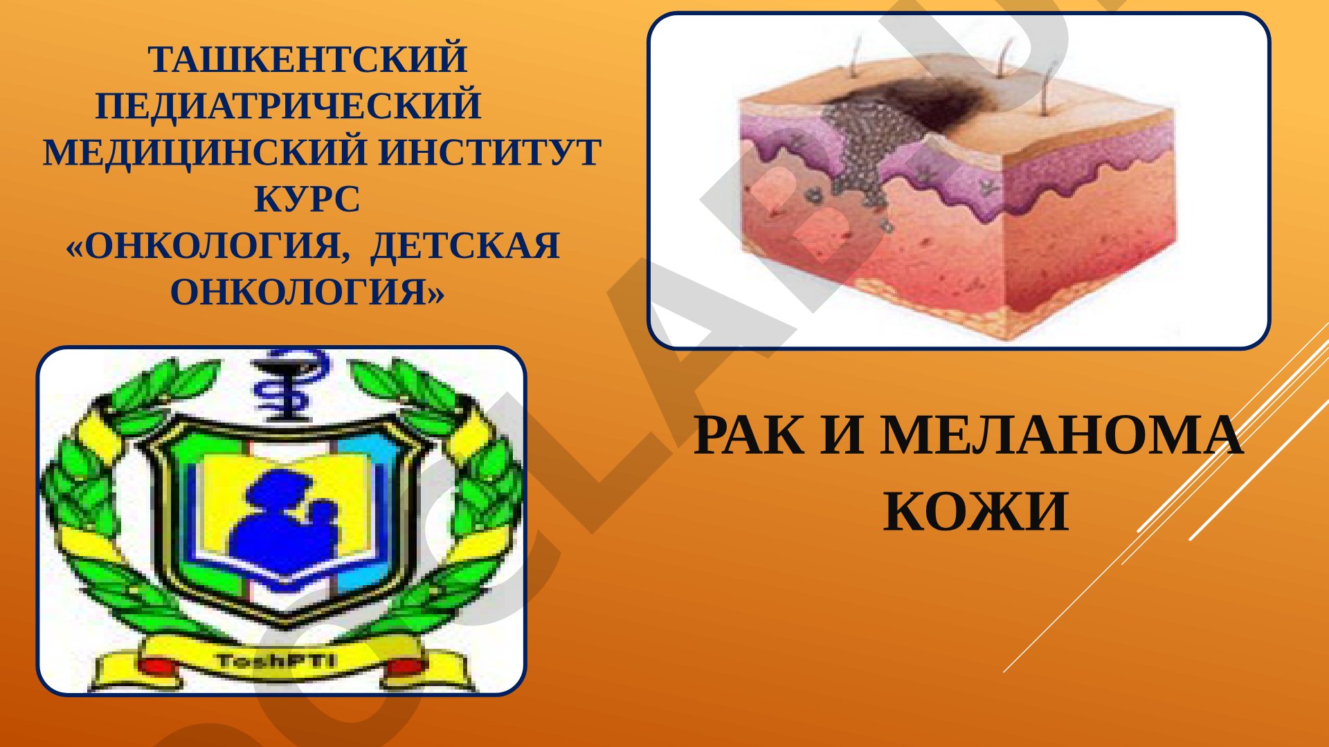 Рак и меланома кожи