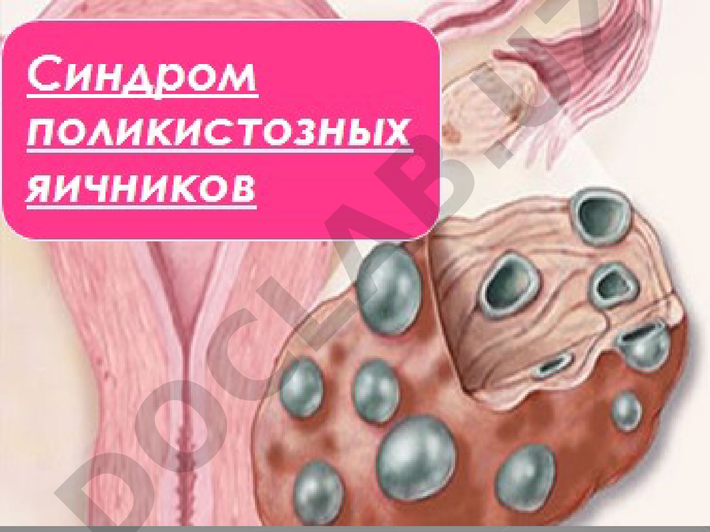 СПКЯ: частота, классификация, причины и патогенез