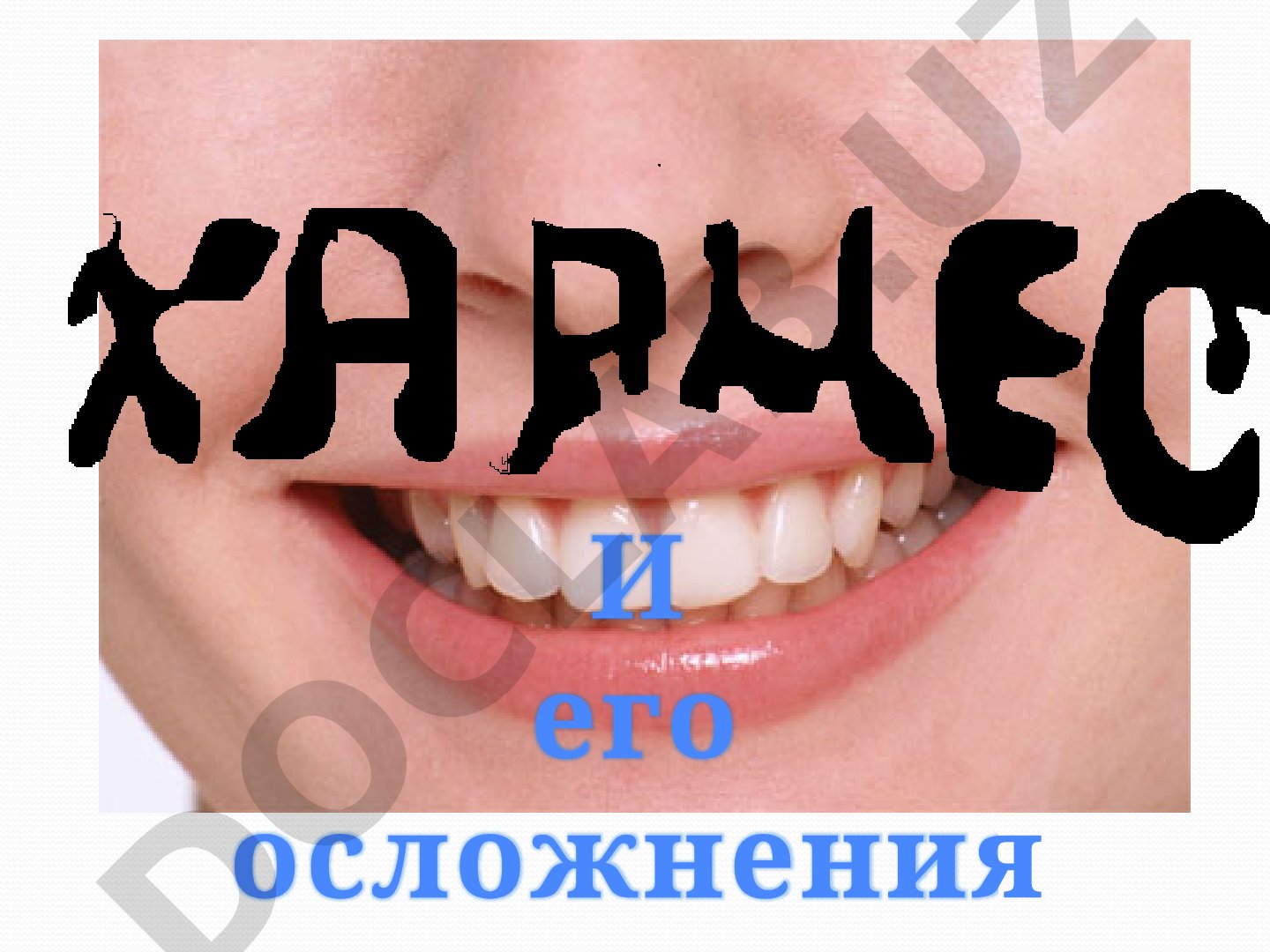 Кариес и его осложнения