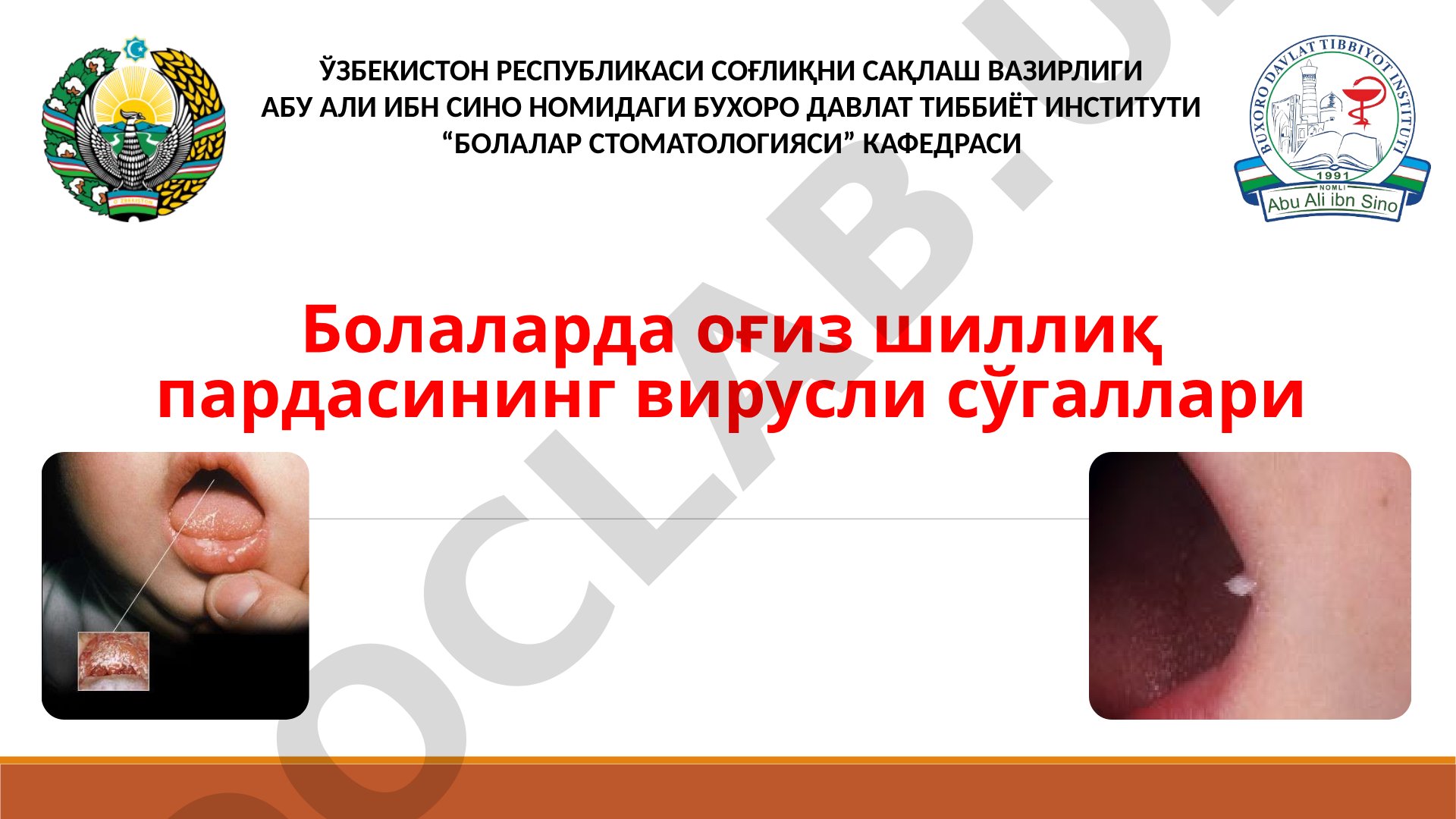Болаларда оғиз шиллиқ пардасининг вирусли сўгаллари