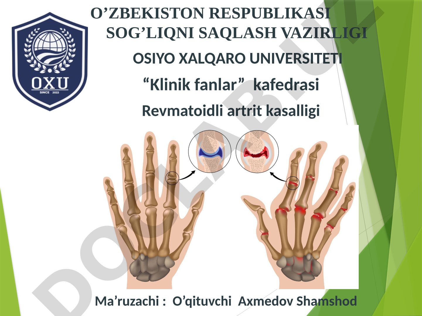 Revmatoid artrit kasalligi: patogenezi, etiologiyasi, A.R.A tashxis mezonlari