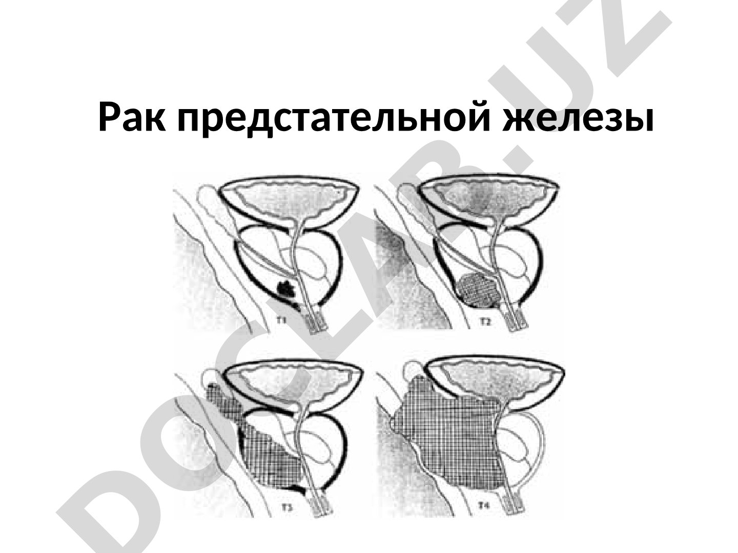 Рак предстательной железы
