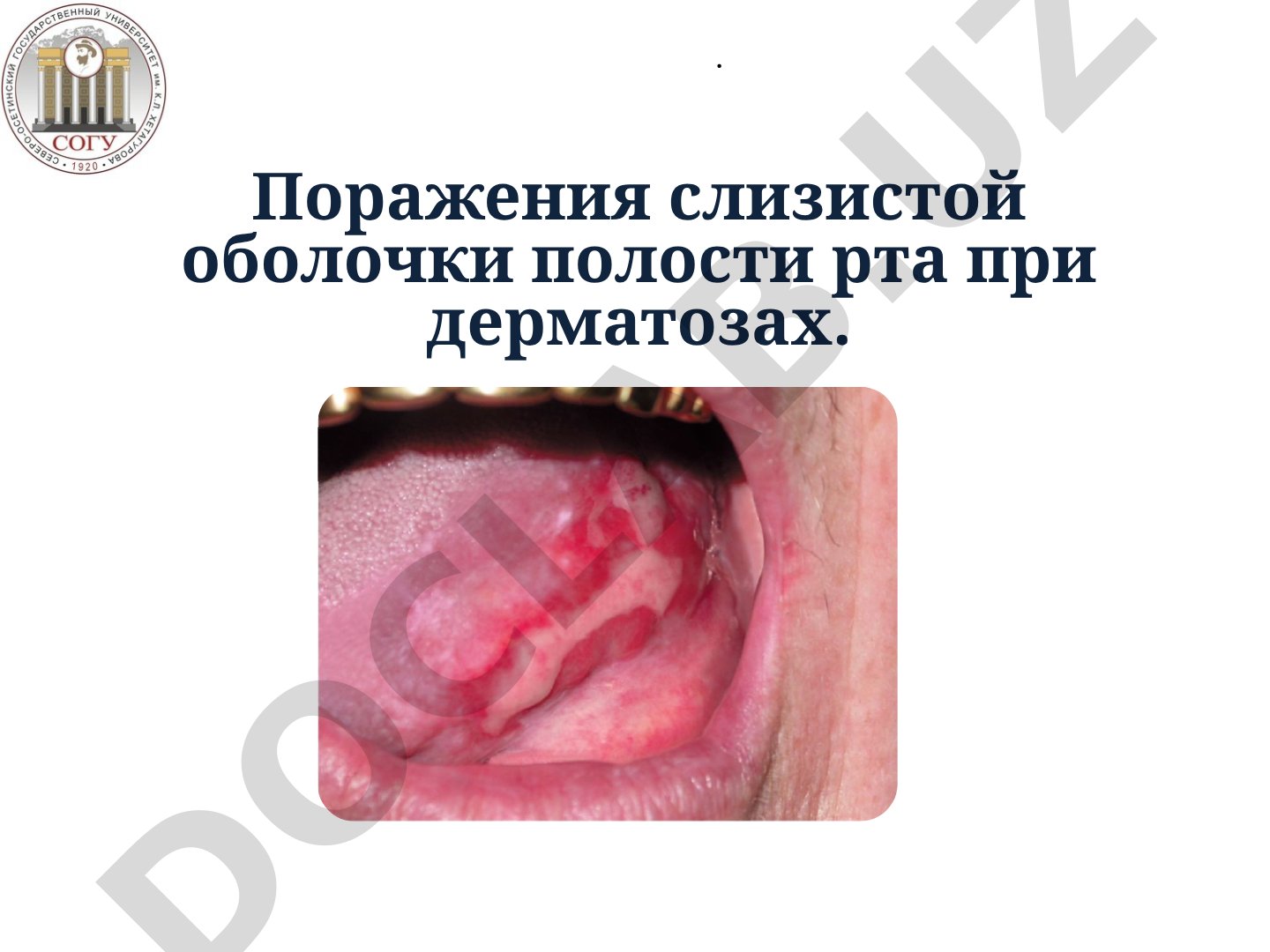 Поражения слизистой оболочки полости рта при дерматозах