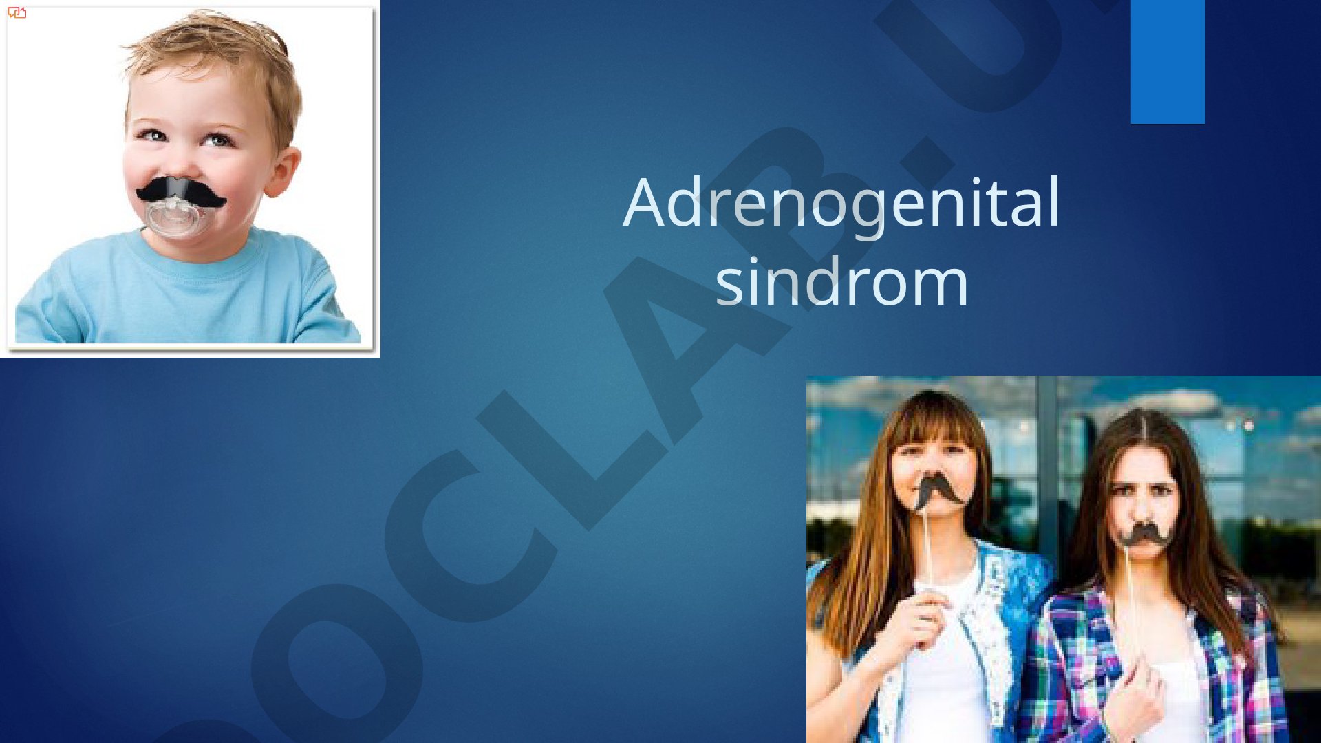 Adrenogenital sindrom
