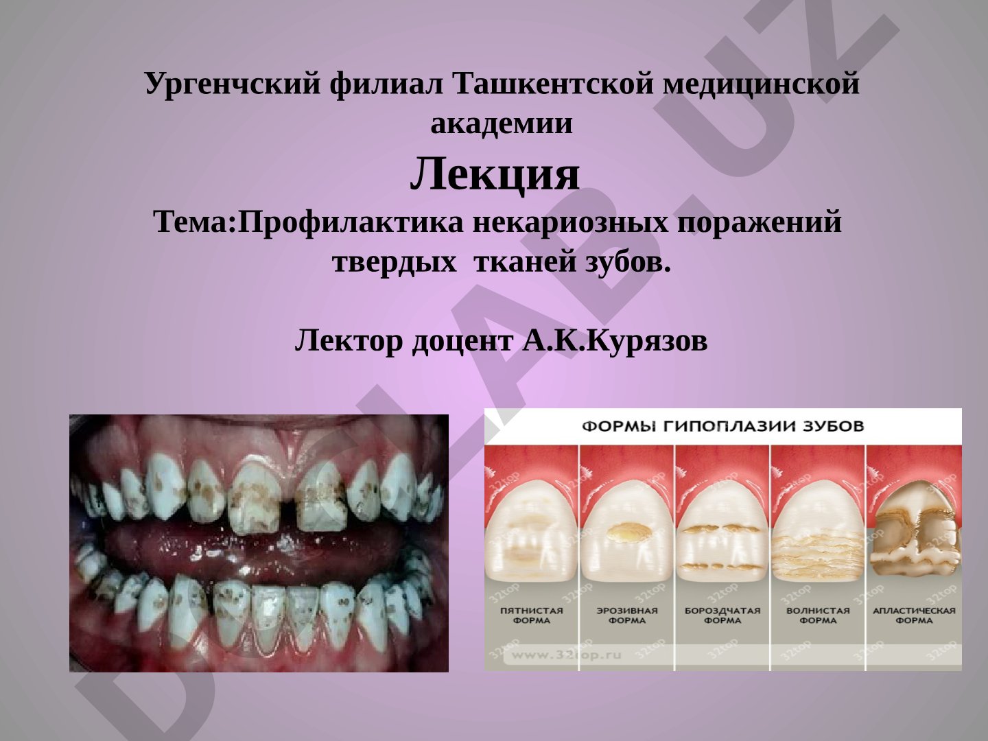 Профилактика некариозных поражений твердых тканей зубов