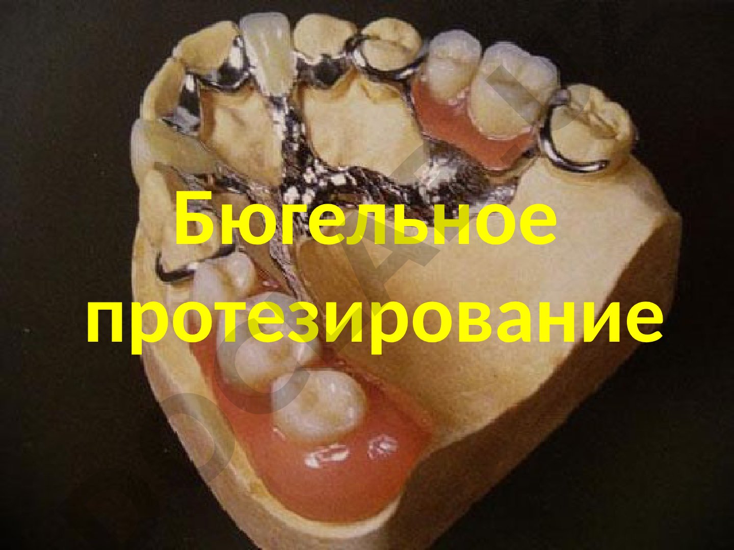 Бюгельное протезирование