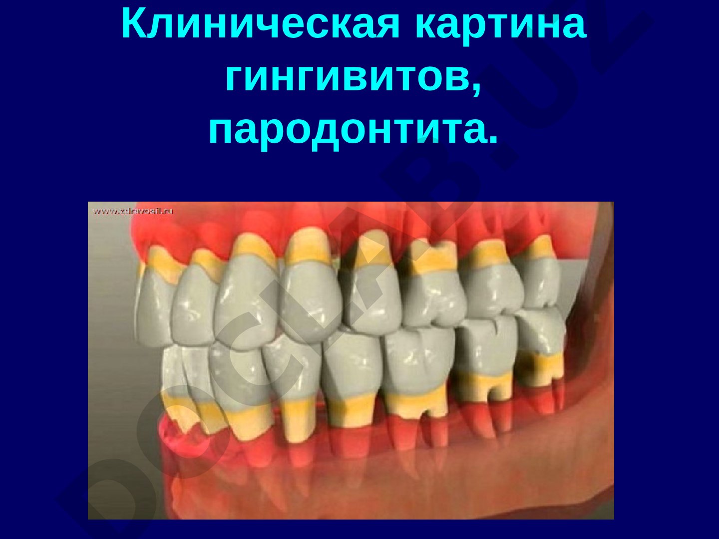 Клиническая картина гингивитов и пародонтита