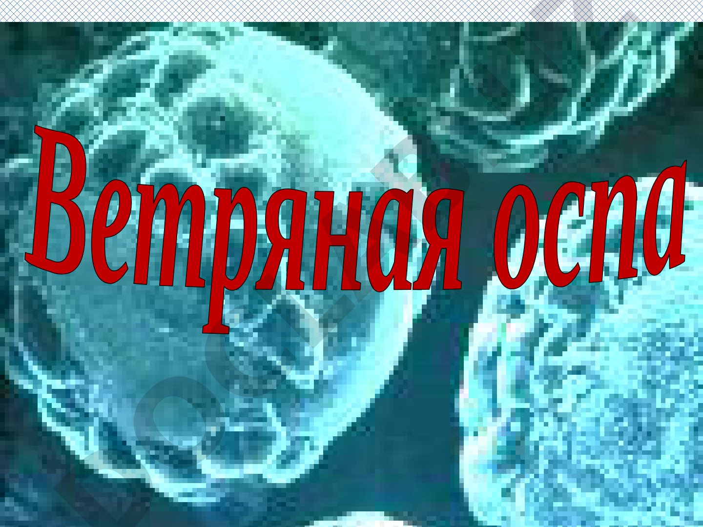 Ветряная оспа