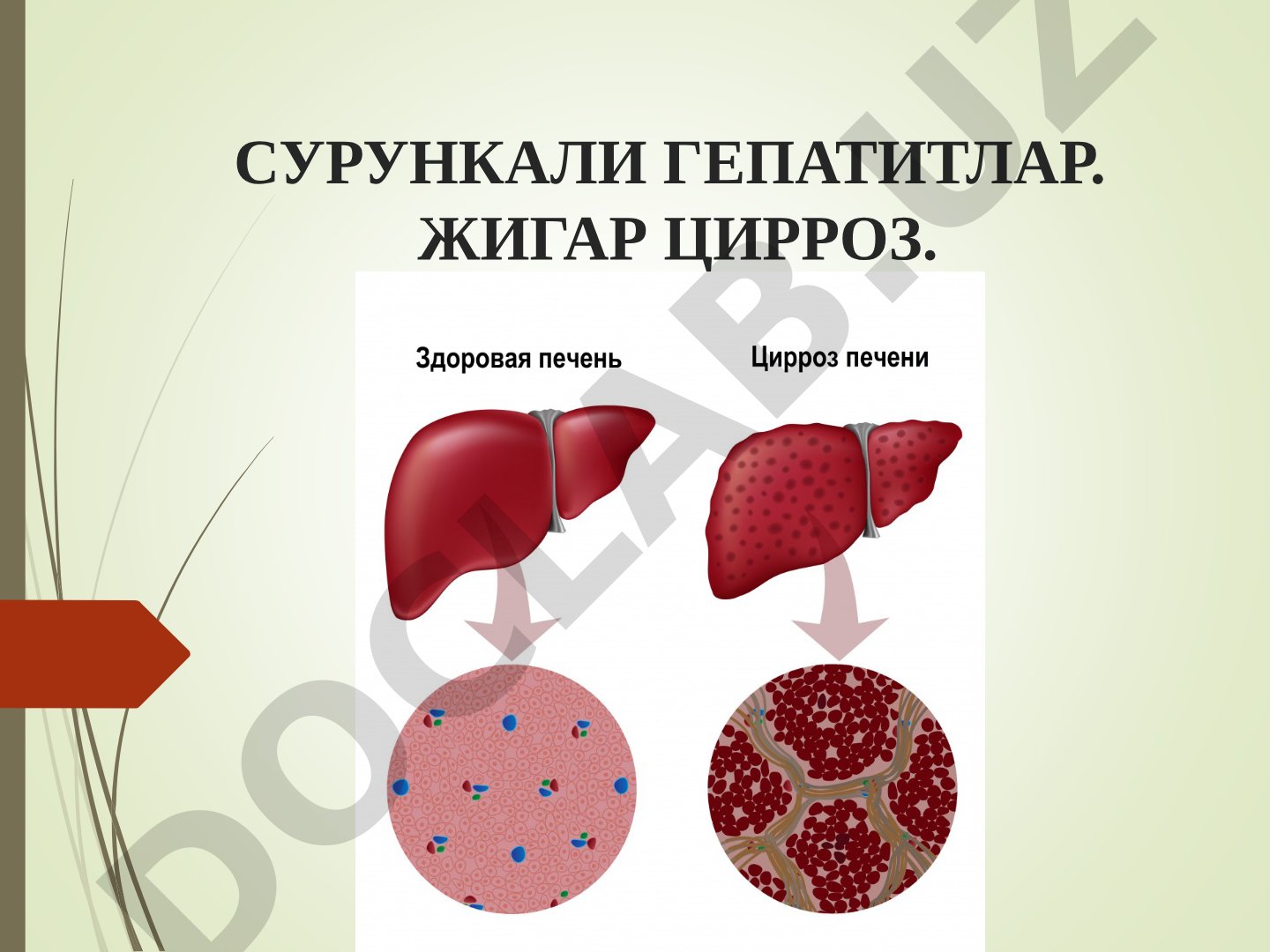 Сурункали гепатитлар. Жигар цирроз